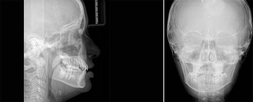 CEFH (Radiografia del Cranio e dei seni nasali)