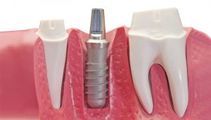 Chirurgia implantare