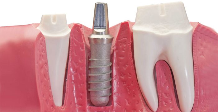 Chirurgia implantare