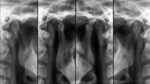 Radiografia dell’ATM Articolazione Temporo-mandibolare Bilaterale