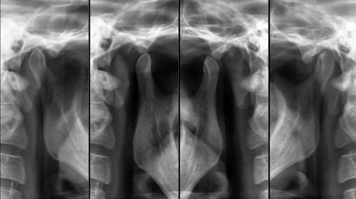 Radiografia dell’ATM Articolazione Temporo-mandibolare Bilaterale