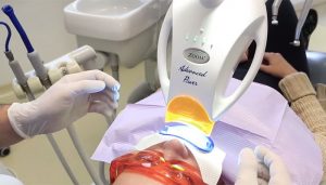 Sbiancamenti dentali