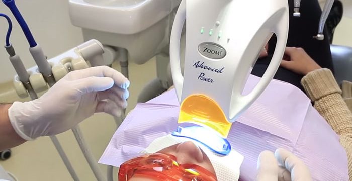 Sbiancamenti dentali